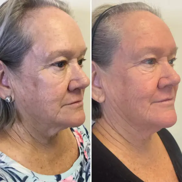sublative and sublime candela medical | Laser Aesthetics AZ Side-by-side collage of a woman’s face and neck showing before (left) and after (right) with smoother skin and fewer wrinkles on the cheek and neck areas.