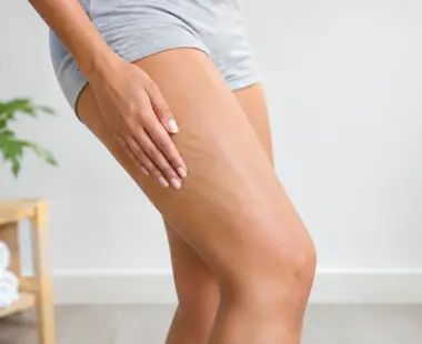 Cellulite Treatment for Thighs That Works | Laser Aesthetics AZ Cellulite Treatment for Thighs That Works
